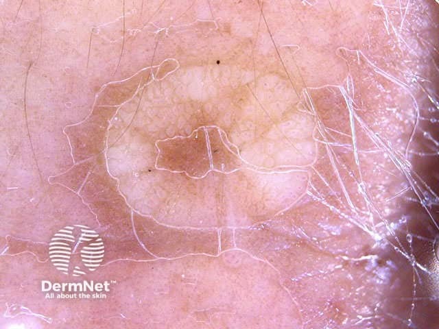 Dermoscopy Other Non melanocytic Lesions Dermoscopy Other Non melanocytic Lesions
