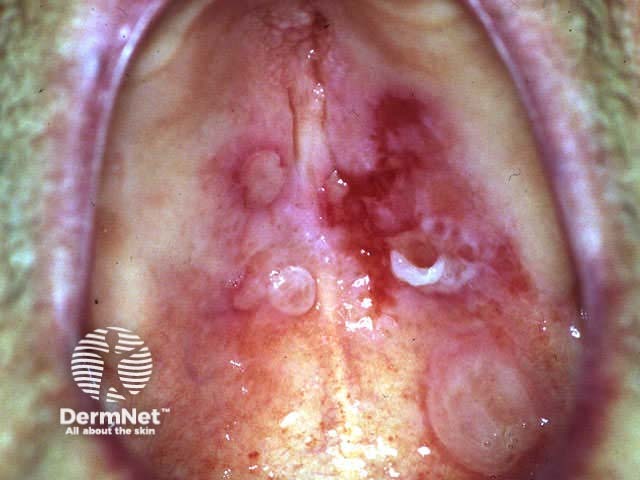 Severe oral cicatricial pemphigoid unresponsive to steroids and dapsone; rituximab is indicated.
