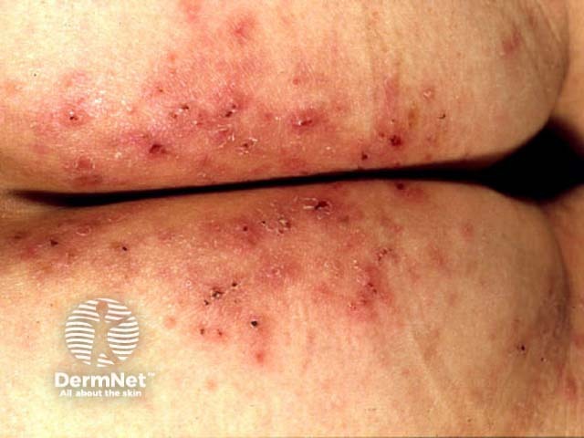 Dermatitis herpetiformis