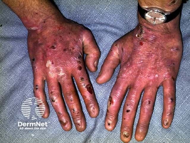 Epidermolysis bullosa