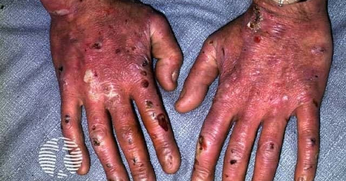 Epidermolysis bullosa image