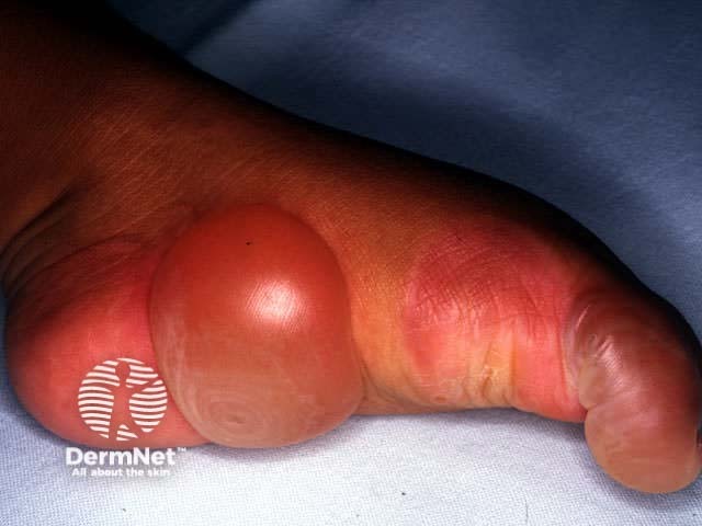 Epidermolysis bullosa