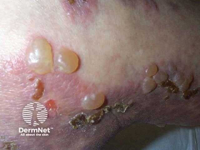 bullous pemphigoid