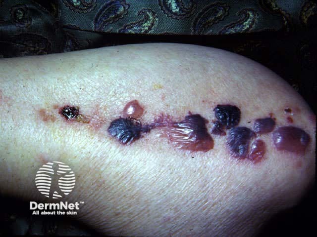 bullous pemphigoid