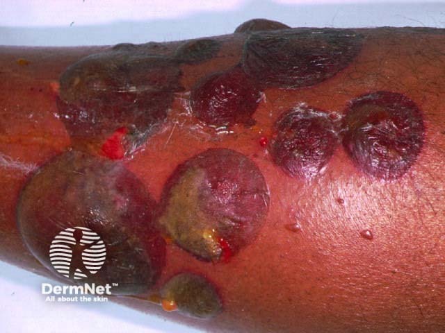 bullous pemphigoid