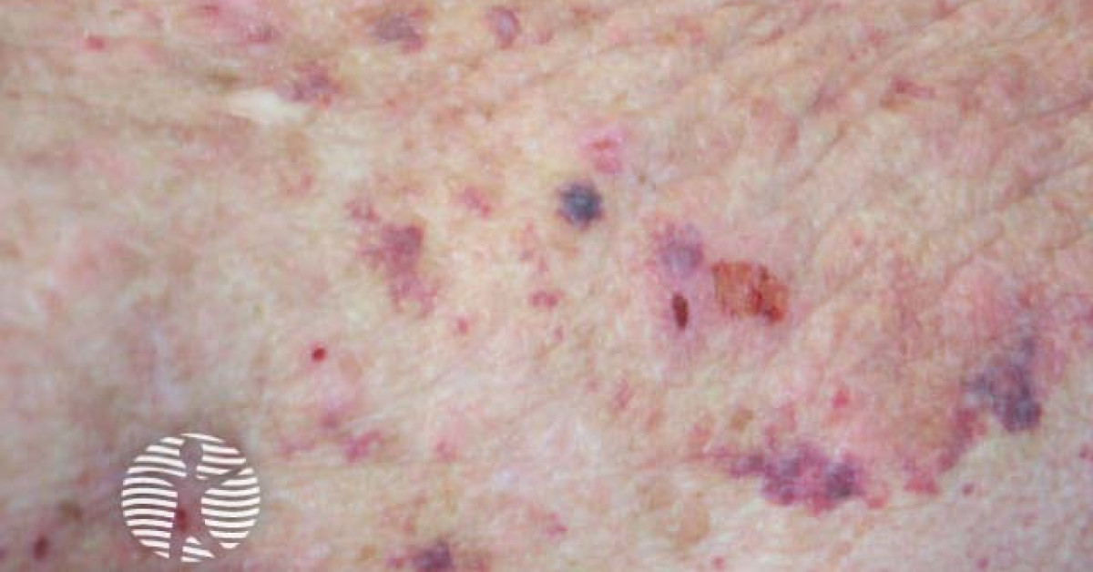 bullous pemphigoid image