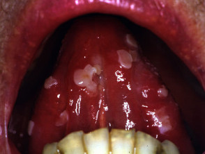 Oral pemphigus