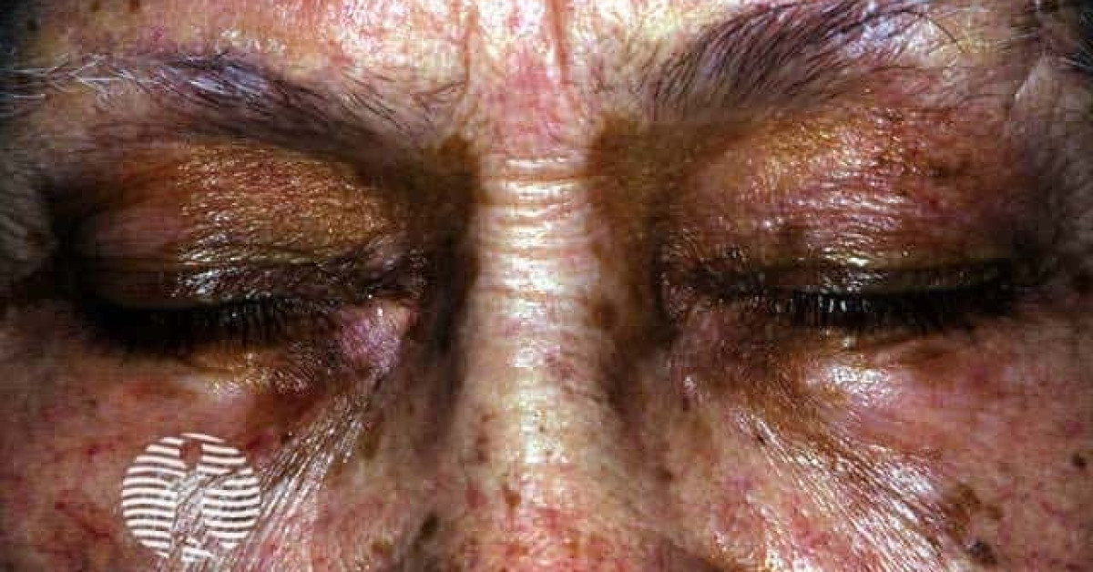 Druginduced photosensitivity eruption image