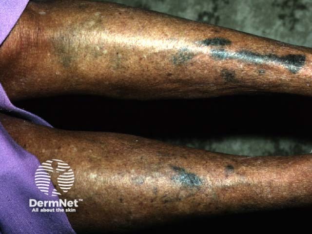 Blue-black pigmentation (minocycline)