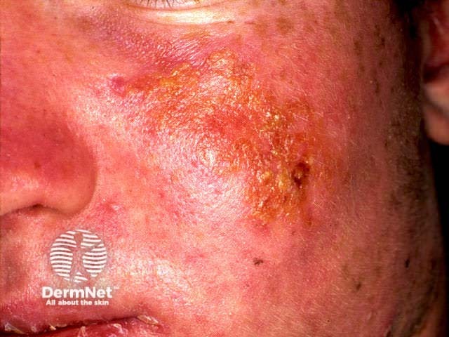 Severe sunburn (isotretinoin)