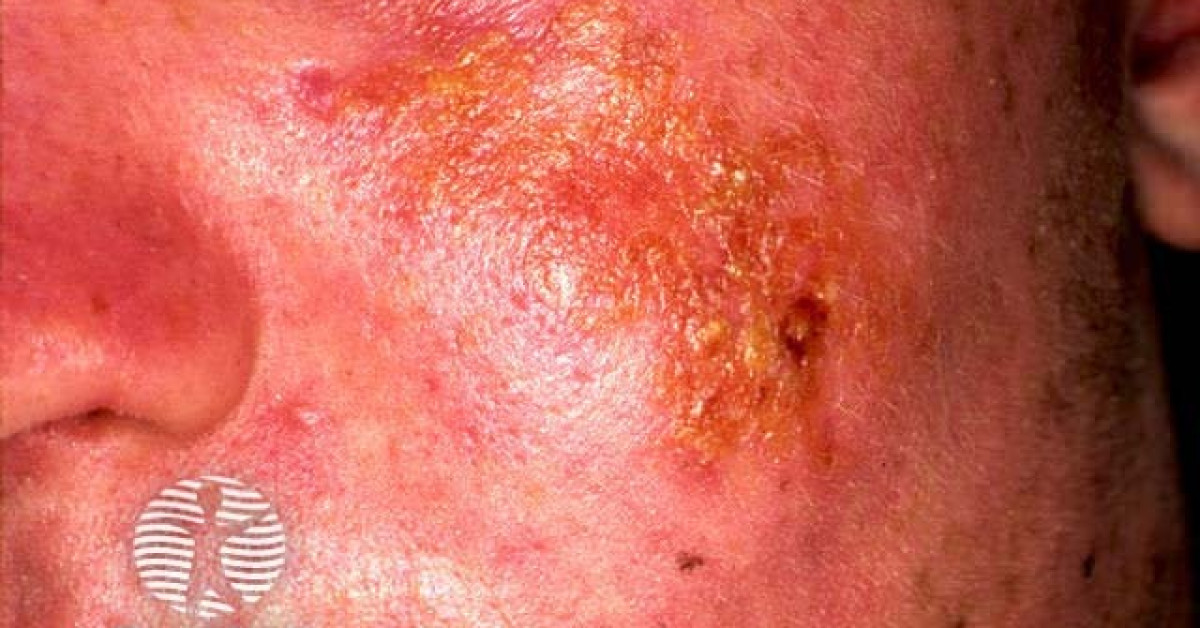 Druginduced photosensitivity eruption image