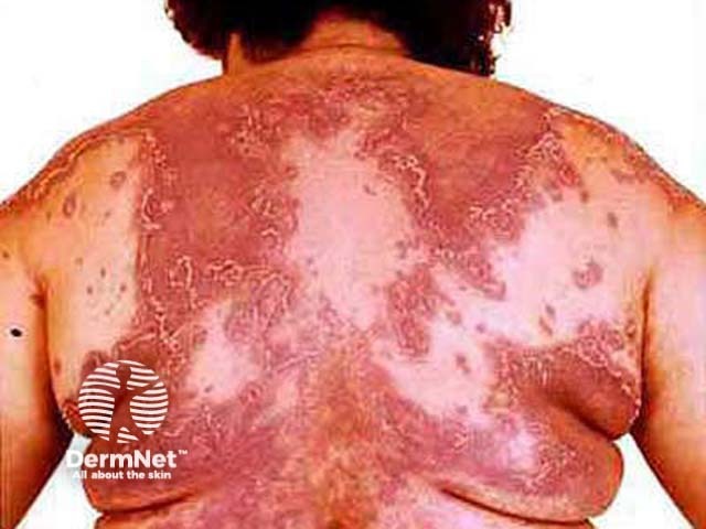 Pustular psoriasis (systemic steroids)