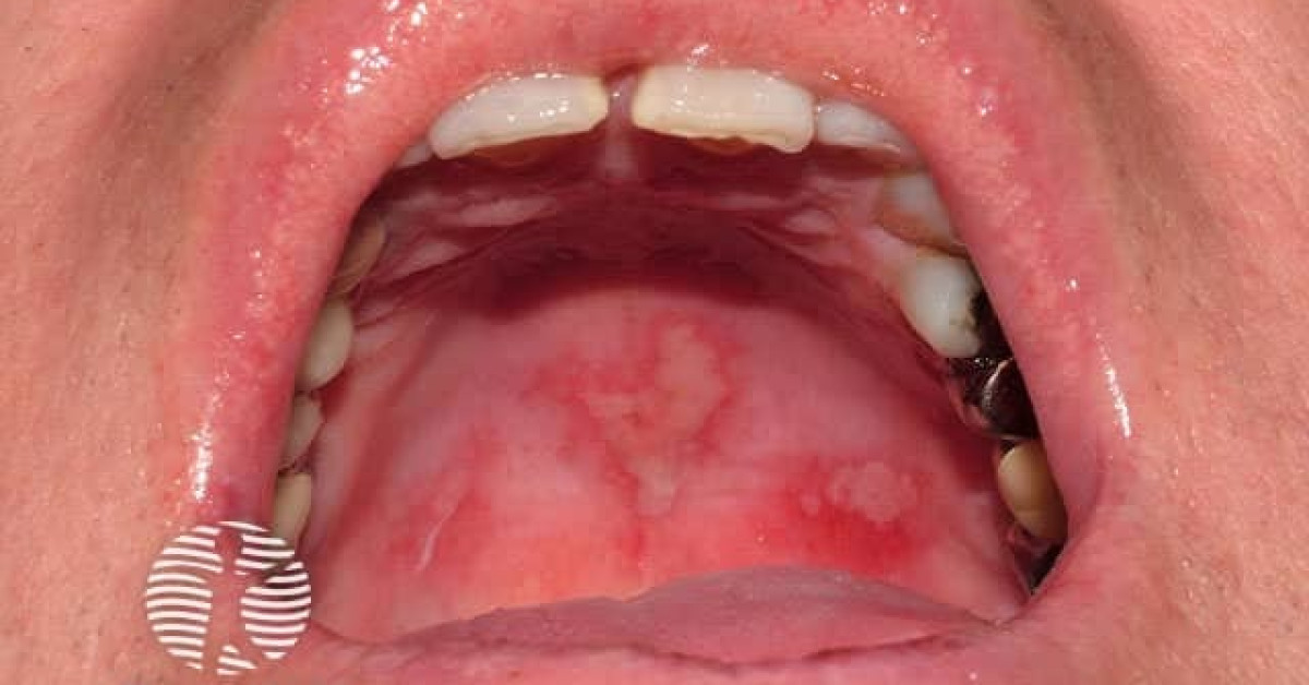 Fixed drug eruption image