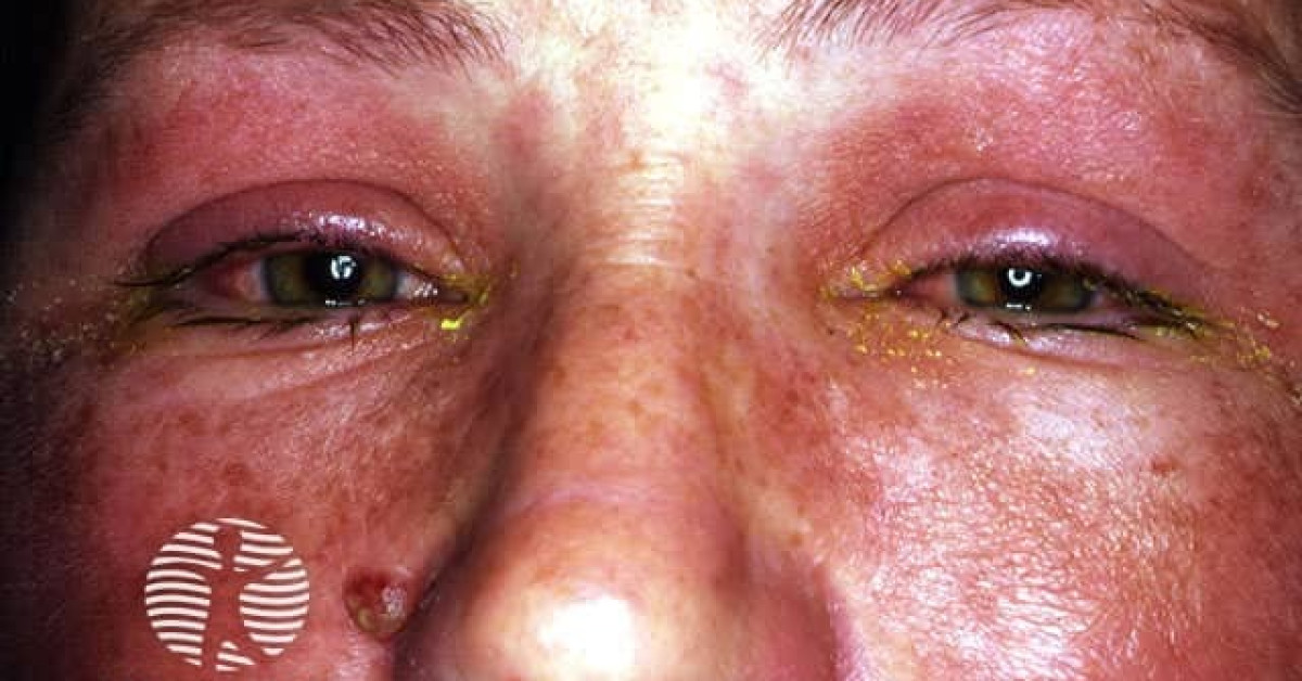 Sjs How Common Stevens-Johnson syndrome image