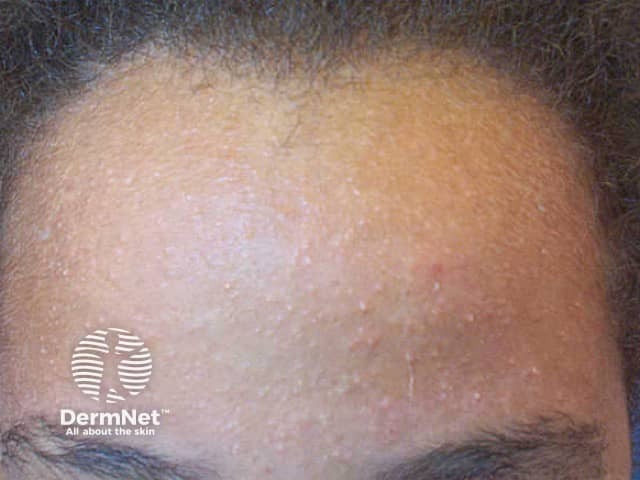 Acne Vulgaris Dermnet
