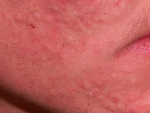 Macrocomedones in acne
