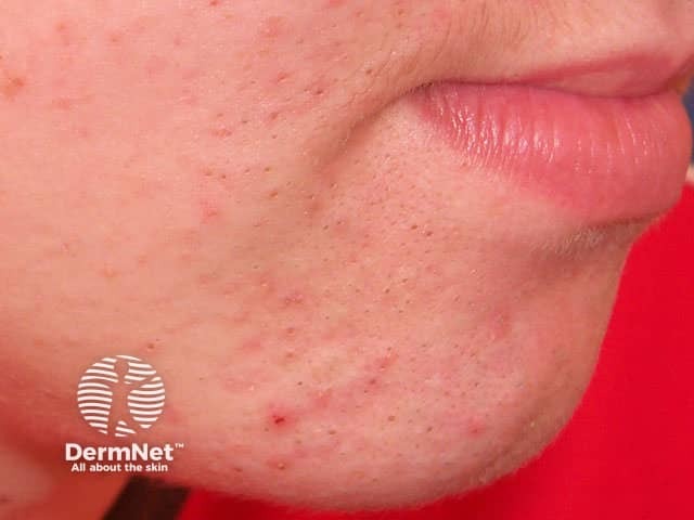 Acne Vulgaris Dermnet
