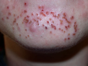 Diathermy to acne comedones