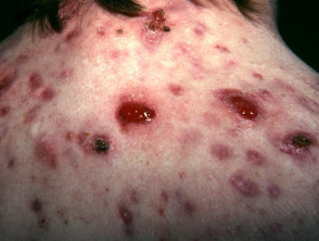Granulomas and crusted acne lesions