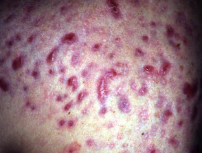 Hypertrophic scarring following acne fulminans