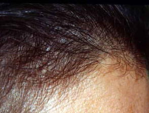 Follicular disorders. Disorders of the hair and scalp | DermNet
