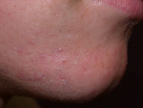Mild acne