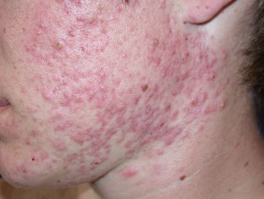 Severe acne
