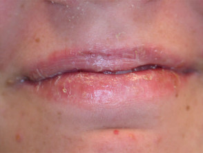 Cheilitis on isotretinoin