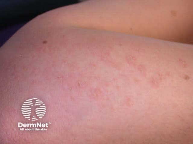 Dermatitis