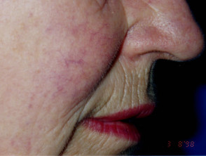 Six weeks after single treatment to rosacea with vascular laser