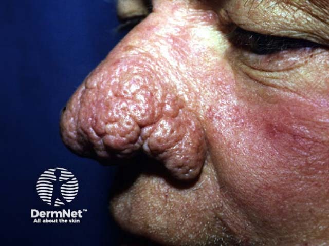 Rhinophyma that should be treated surgically