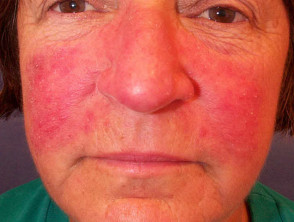 Inflamed rosacea resulting in sensitive skin