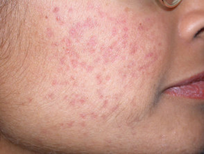 Postinflammatory erythema due to acne