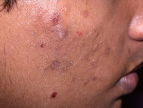 Postinflammatory pigmentation due to acne