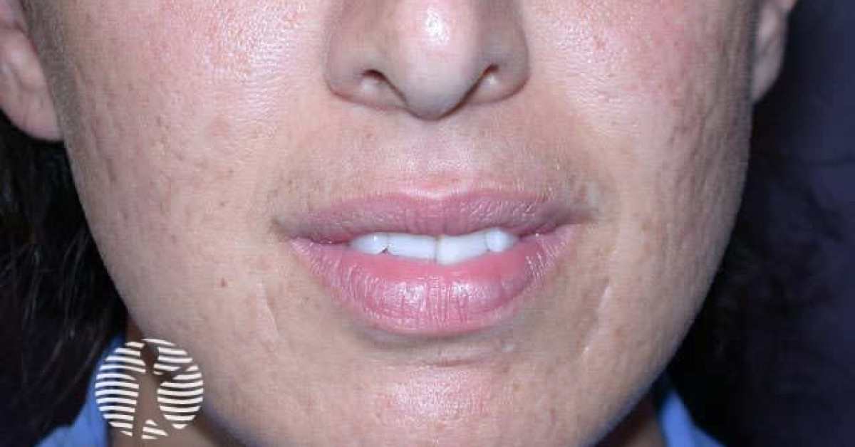 Atrophic acne scars image
