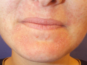 Dryness caused by topical retinoid