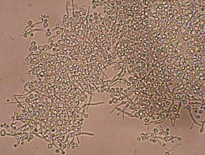 Candida albicans: microscopy and culture