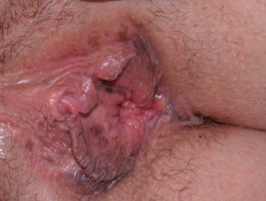 Candidal vulvovaginitis
