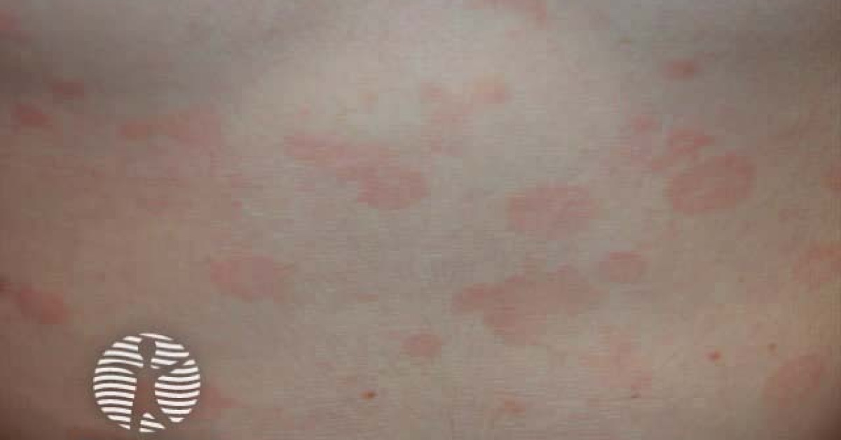 DermNet® - Pityriasis versicolor image