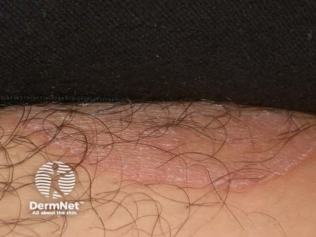 Tinea cruris