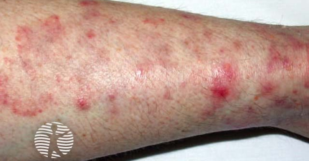 Tinea corporis image