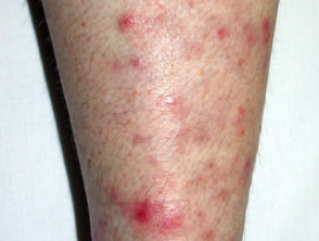 Tinea Corporis (Body Ringworm) - Dermatologic Disorders - Merck