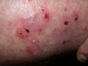 Tinea Capitis (Scalp Ringworm) - Dermatologic Disorders - Merck Manuals  Professional Edition