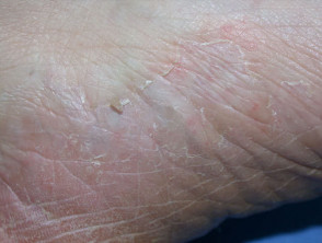 Fungal skin infections. Tinea pedis