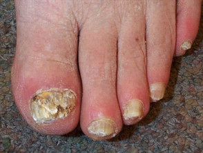 Total nail destruction due to fungal infection