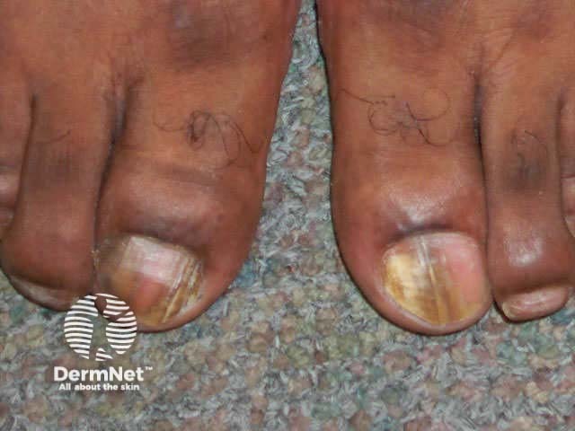 Lateral onychomycosis