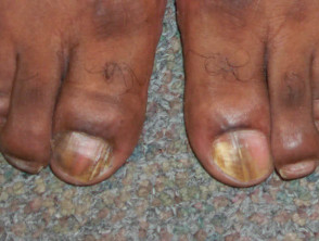 Lateral onychomycosis