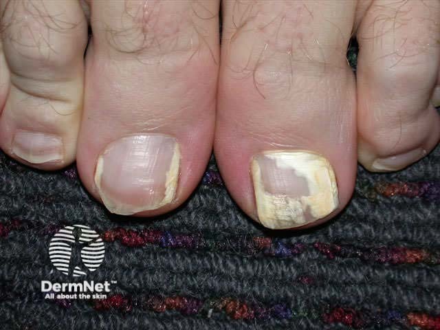Superficial white onychomycosis