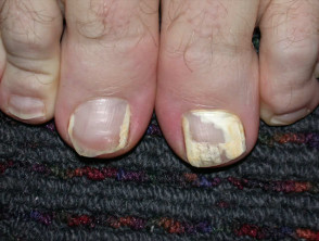 Superficial white onychomycosis