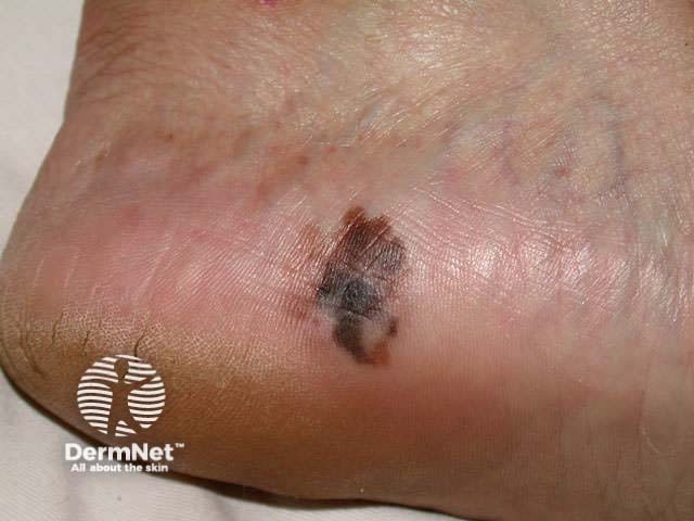 Acral lentiginous malignant melanoma - irregular edge, with variable pigmentation, asymmetry and areas of regression on the heel